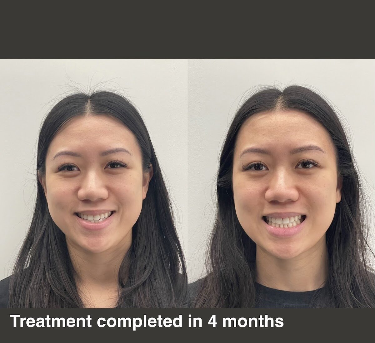 Invisalign before and after, treatment completed in 4 months