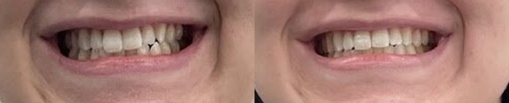 Invisalign before and after, treatment completed in 4 months
