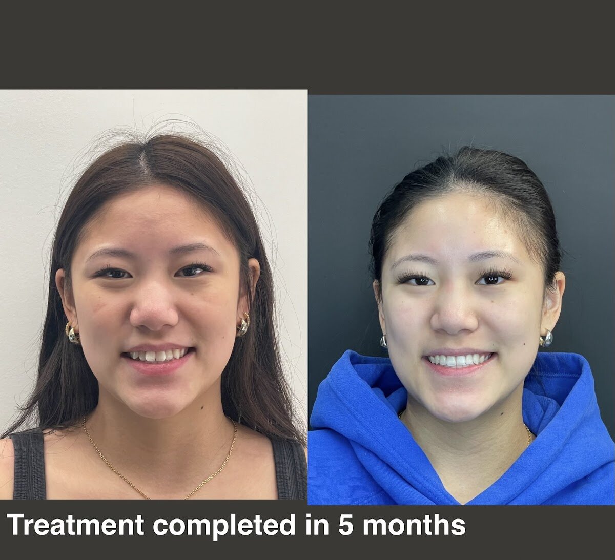 Invisalign before and after, treatment completed in 5 months