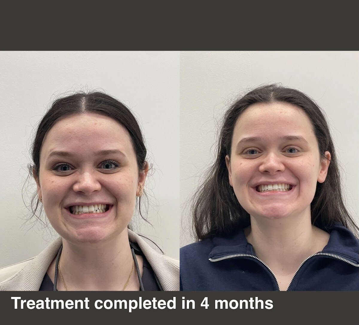 Invisalign before and after, treatment completed in 4 months